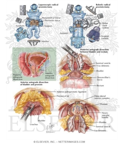 Malignant Prostate Surgery I: Laparoscopic and Robotic