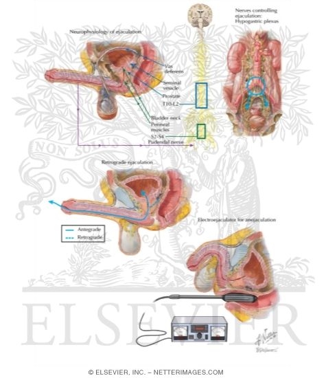 Watermarked preview of labeled image: Ejaculatory Disorders