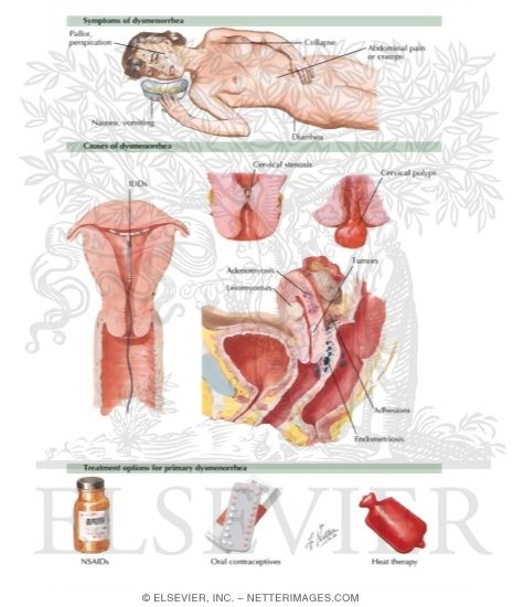 Watermarked preview of labeled image: Dysmenorrhea