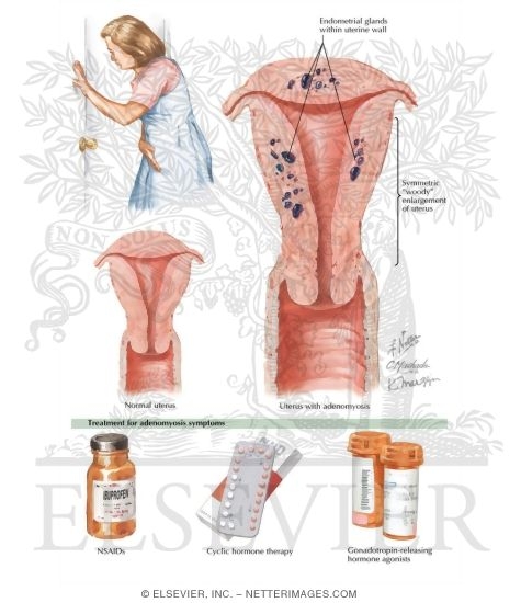 Watermarked preview of labeled image: Adenomyosis