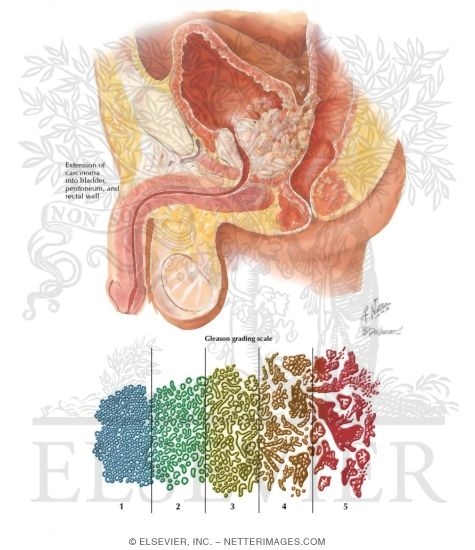 Watermarked preview of labeled image: Carcinoma of Prostate I: Epidemiology, Prostate-Specific Antigen, Staging, and Grading
