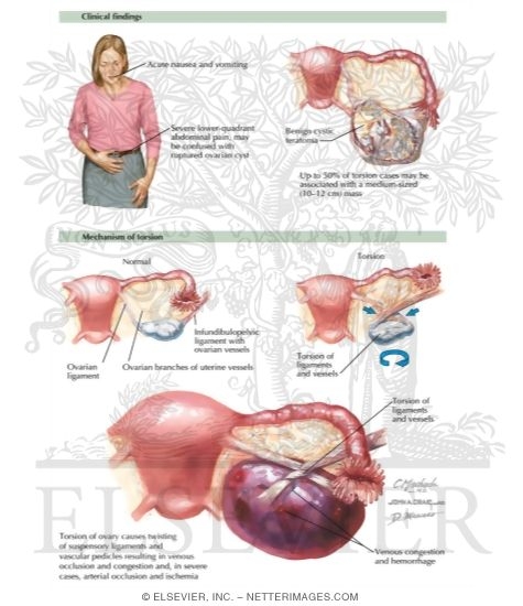 Adnexal Torsion