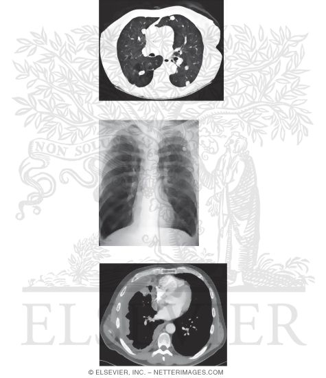 Watermarked preview of unlabeled image: Radiologic Examination of the Lungs