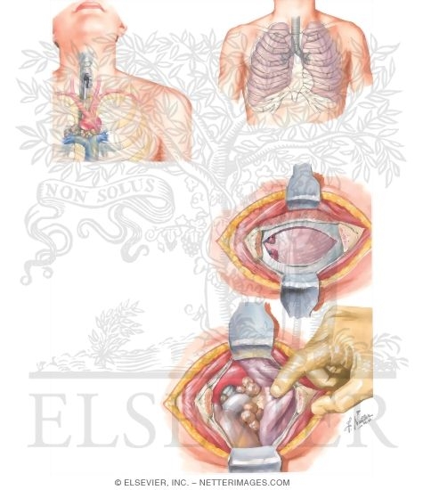 Mediastinotomy and Mediastinoscopy