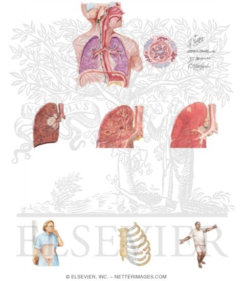 Watermarked preview of unlabeled image: Chronic Cough