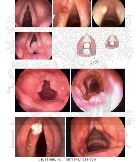 Watermarked preview of unlabeled image: Common Laryngeal Lesions