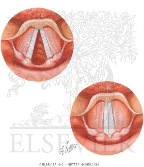 Watermarked preview of unlabeled image: Vocal Cord Dysfunction