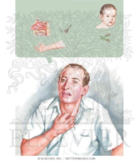 Watermarked preview of unlabeled image: Bronchial Asthma