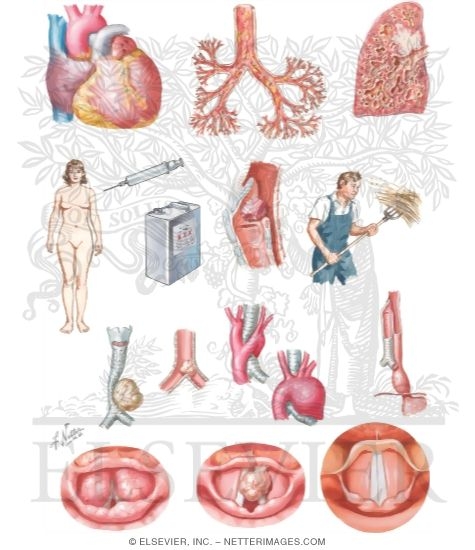 Watermarked preview of unlabeled image: Bronchial Asthma