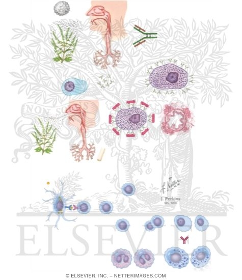 Watermarked preview of unlabeled image: Bronchial Asthma