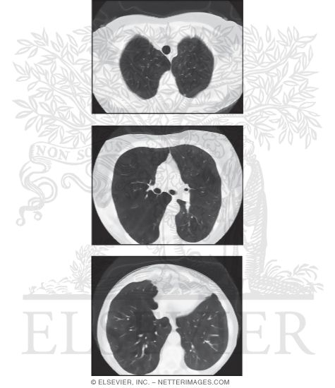 Watermarked preview of unlabeled image: Chronic Obstructive Pulmonary Disease