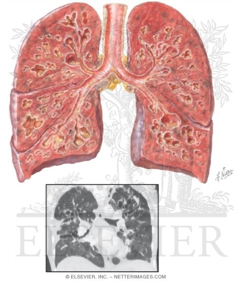 Bronchiectasis