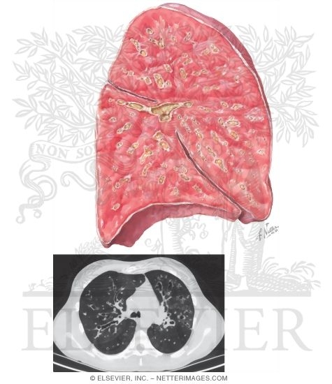 Watermarked preview of unlabeled image: Cystic Fibrosis