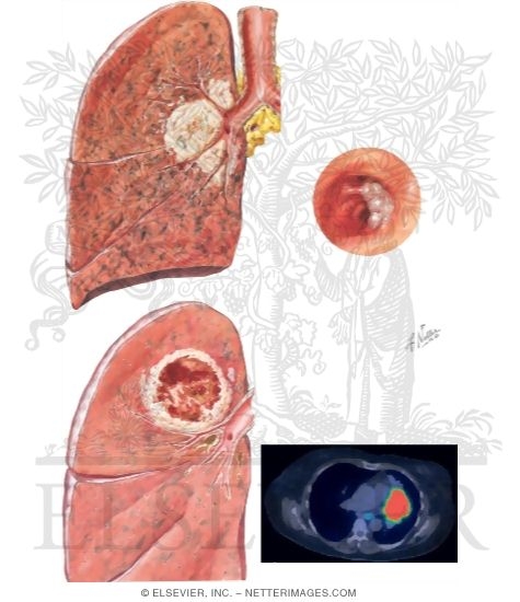 Squamous Cell Carcinoma of the Lung