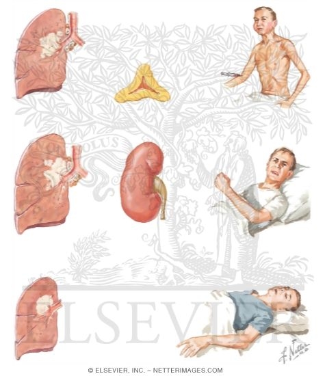 Paraneoplastic Manifestations of Lung Cancer