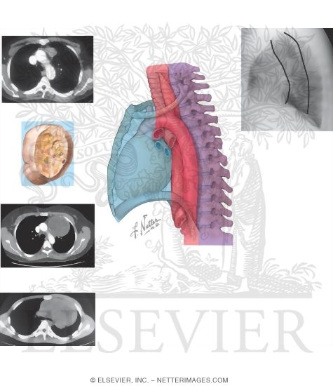 Mediastinal Tumors: Anterior Mediastinum
