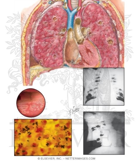 Watermarked preview of unlabeled image: Staphylococcus Aureus Pneumonia