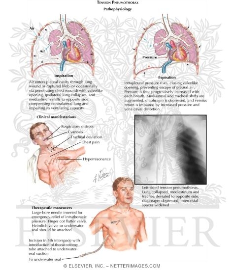 Tension Pneumothorax