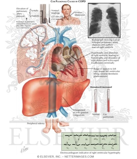Cor Pulmonale