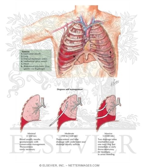 Hemothorax
Sources of Hemothorax