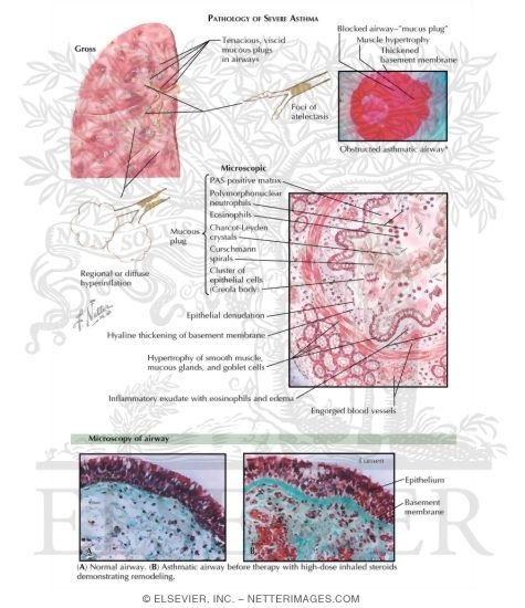 Watermarked preview of labeled image: Pathology of Status Asthmaticus
Pathology of Asthma