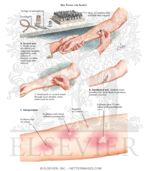 Watermarked preview of labeled image: Skin Testing for Allergy