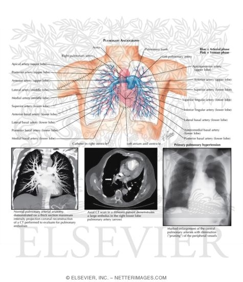 Watermarked preview of labeled image: Pulmonary Angiography