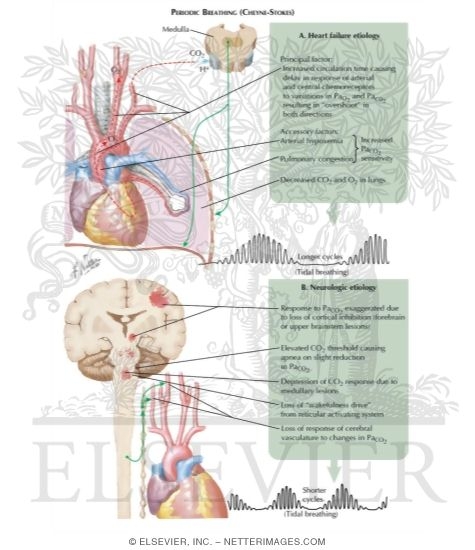 Watermarked preview of labeled image: Periodic Breathing (Cheyne-Stokes)