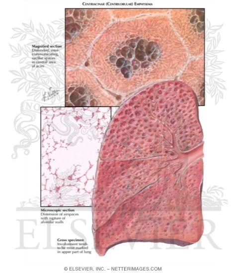 Centriacinar (Centrilobular) Emphysema