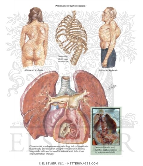 Kyphoscoliosis, Pathology