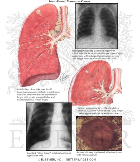 Initial (Primary) Tuberculous Complex