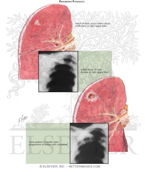 Watermarked preview of labeled image: Pulmonary Tuberculosis - Progressive Pathology