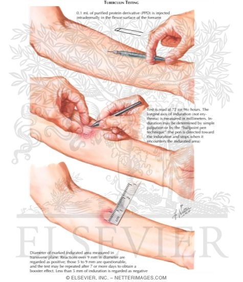 Tubercolin Tuberculin Testing