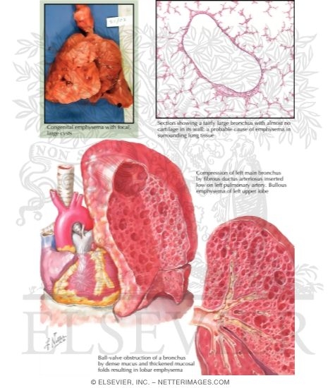 Congenital Lobar Emphysema