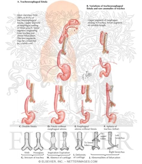 Watermarked preview of labeled image: Tracheoesophageal Fistula