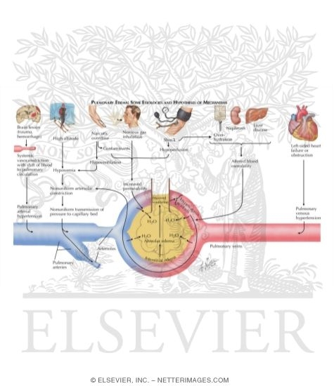 Watermarked preview of labeled image: Pulmonary Edema; Some Etiologies and Hypotheses of Mechanisms