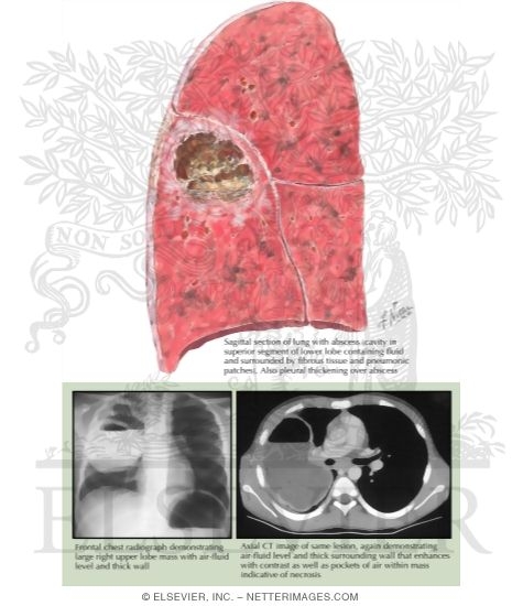 Watermarked preview of labeled image: Lung Abscess