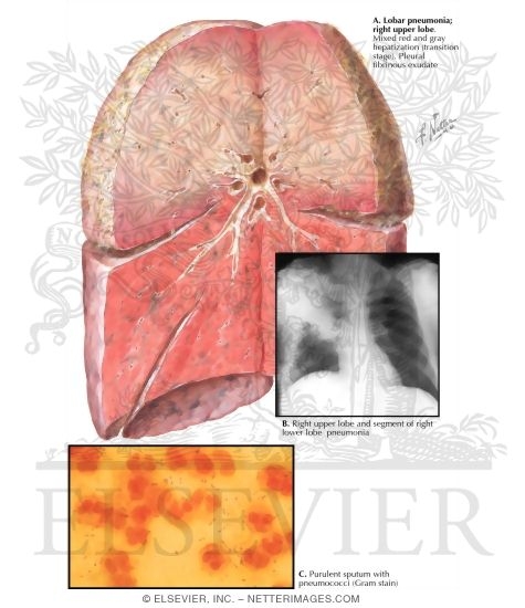 Pneumococcal Pneumonia