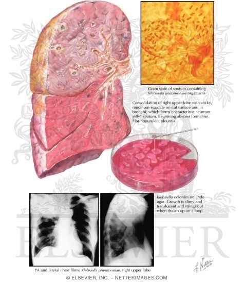 Watermarked preview of labeled image: Klebsiella (Friedlander's) Pneumonia