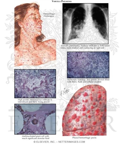 Varicella Pneumonia