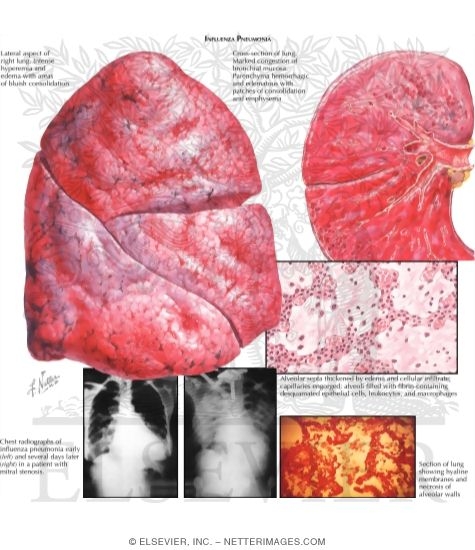 Influenzal Pneumonia