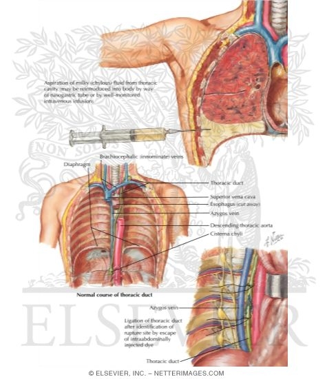 Chylothorax