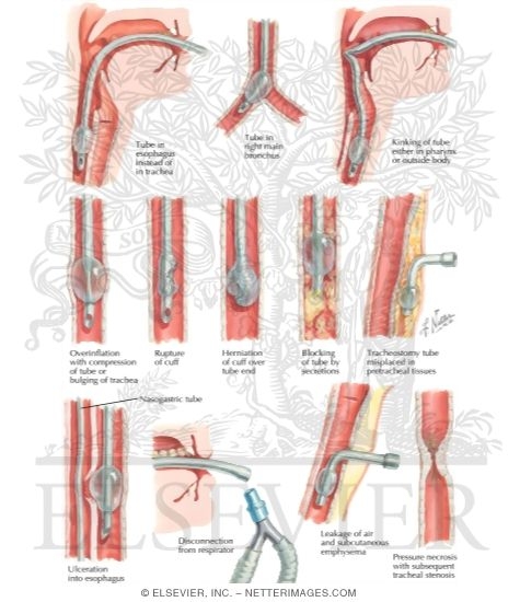 Watermarked preview of labeled image: Morbidity of Endotracheal Intubation and Tracheostomy