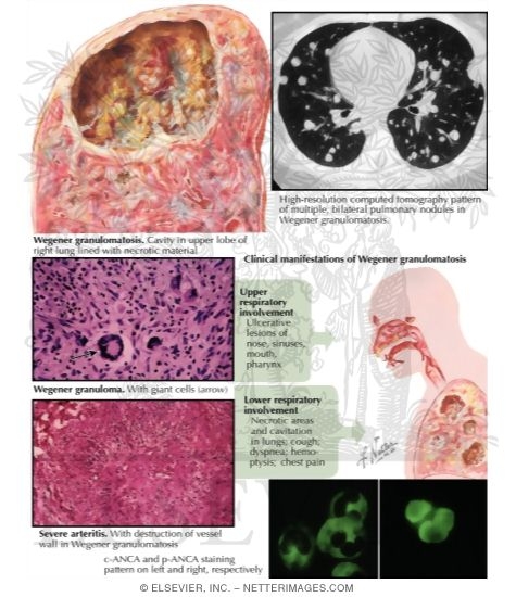 Watermarked preview of labeled image: Major Causes and Symptoms of Nephrogenic Diabetes Insipidus (Continued)