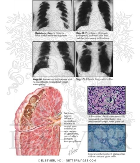 Watermarked preview of labeled image: Sarcoidosis
