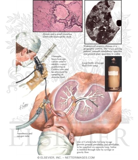 Watermarked preview of labeled image: Alveolar Proteinosis