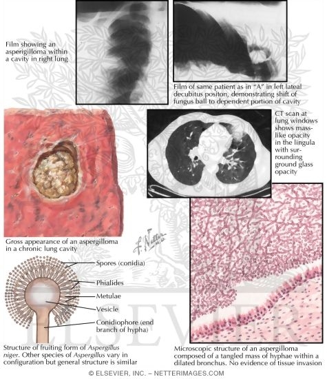 Aspergillosis