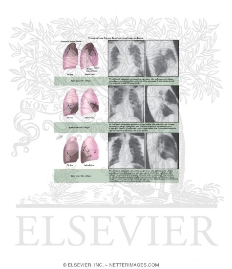 Patterns of Lobar Collapse; Right Lung (after Lubert and Krause)