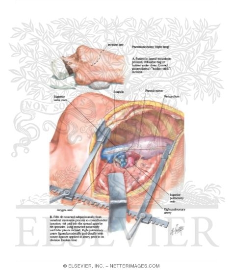 Pneumonectomy; Lung Volume Reduction