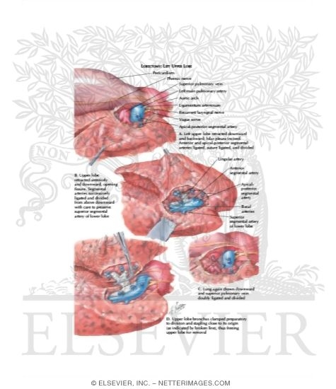 Lobectomy (Left Upper Lobe)